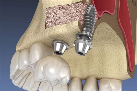 ar periodontal & implant associates|Arkansas Periodontal & Implant Associates: Dr. Michael Curry